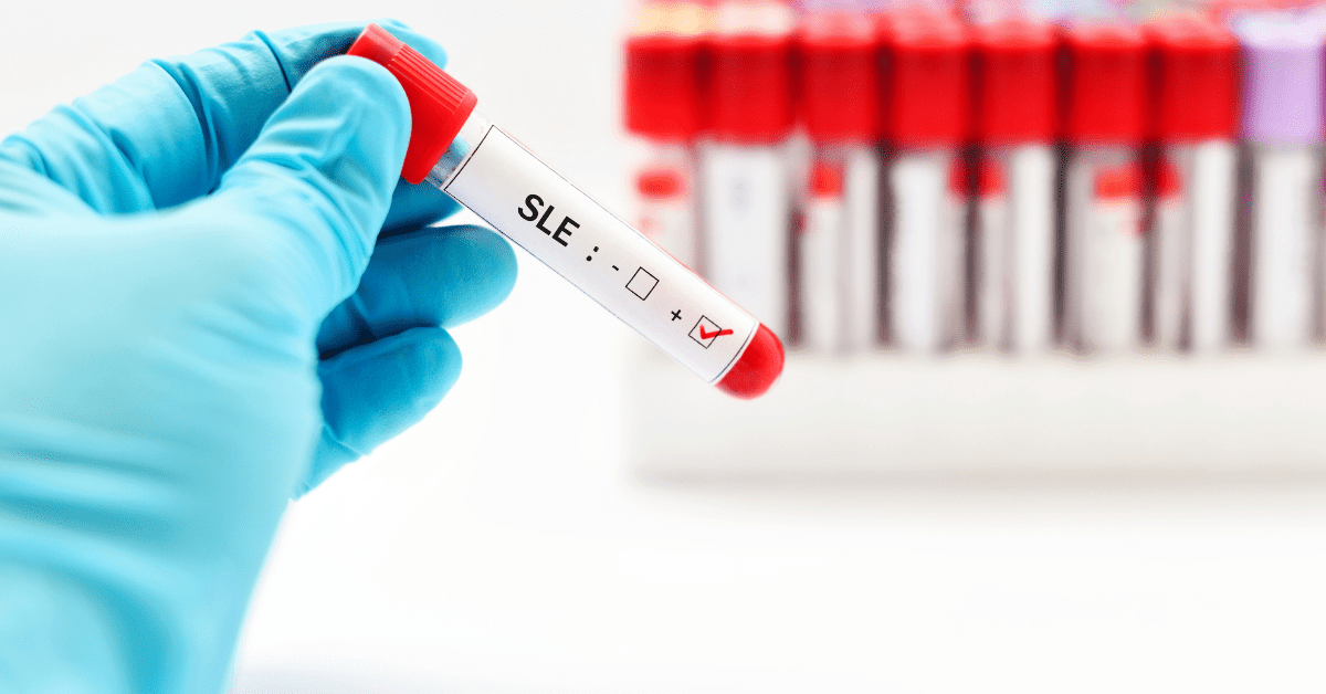 Systemic Lupus Blood sample