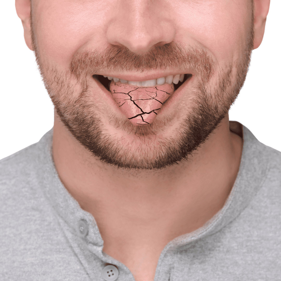 Dry tongue with cracks in it